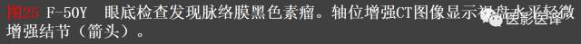 成人眼眶肿瘤：临床、影像、与病理回顾