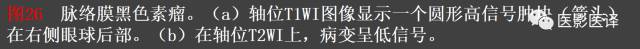 成人眼眶肿瘤：临床、影像、与病理回顾
