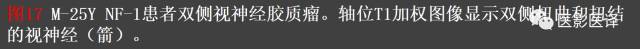 成人眼眶肿瘤：临床、影像、与病理回顾