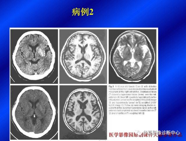 【病例】非酮症高血糖合并偏侧舞蹈症1例CT影像表现