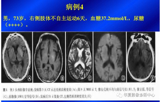 【病例】非酮症高血糖合并偏侧舞蹈症1例CT影像表现