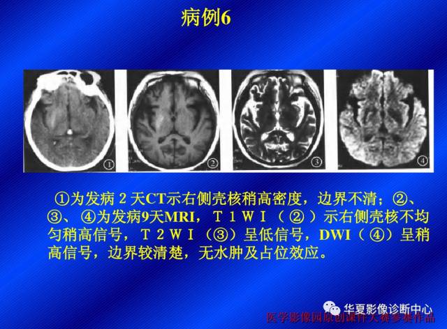【病例】非酮症高血糖合并偏侧舞蹈症1例CT影像表现
