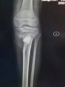 【病例】胫骨骨肉瘤1例X线影像表现