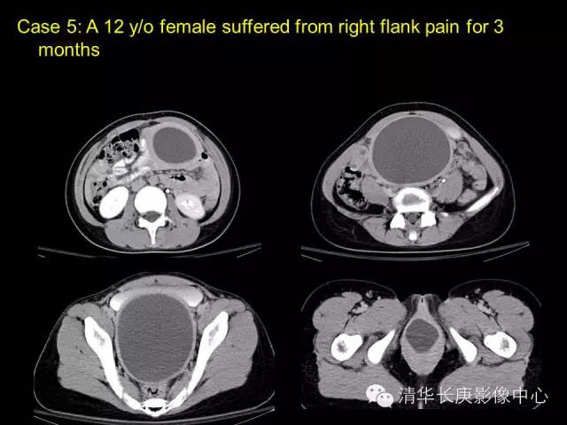 【病例】先天性阴道闭锁1例CT影像表现