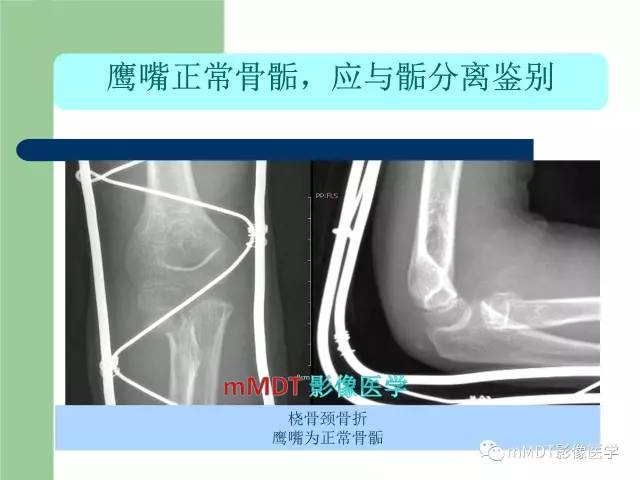 【PPT】儿童肘关节骨折的X线诊断