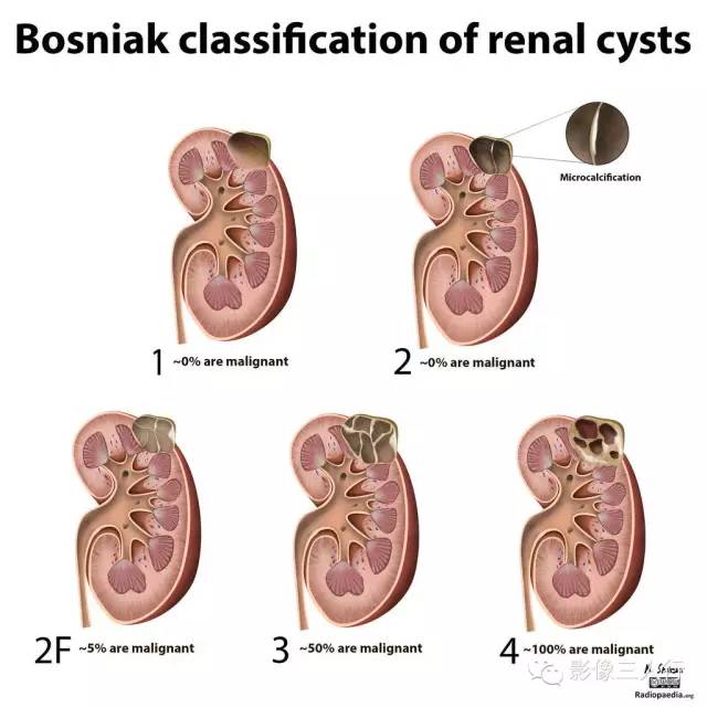 肾脏囊性病变Bosnaik分型