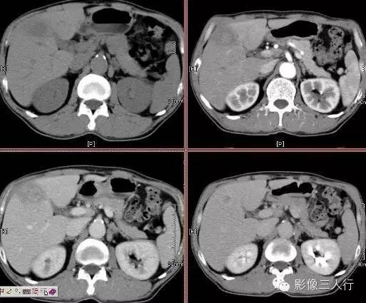 肝脏炎性假瘤 Inflammatory  Pseudotumor，IPT