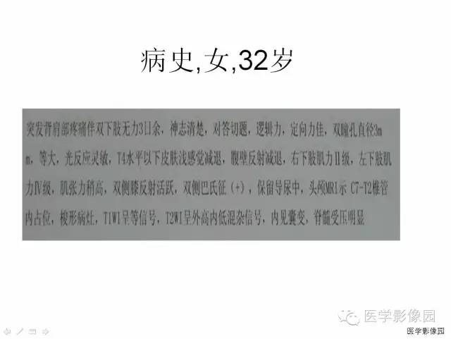 【病例】自发性脊髓硬膜外血肿1例MR影像表现