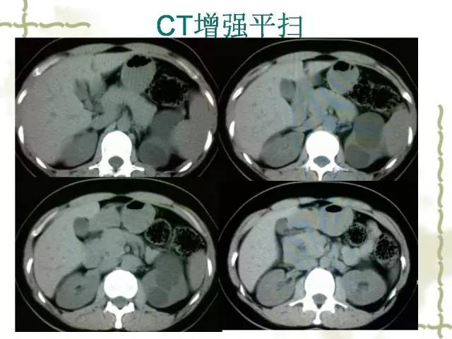 【病例】腹膜后平滑肌肉瘤1例CT影像表现