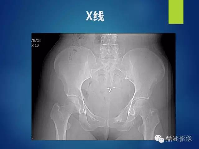 【病例】耻骨黏液型软骨肉瘤1例X线CT影像表现