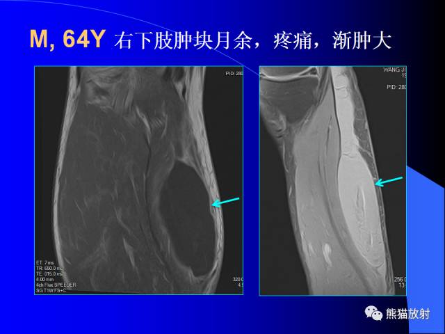 【PPT】膝关节周围囊肿MRI