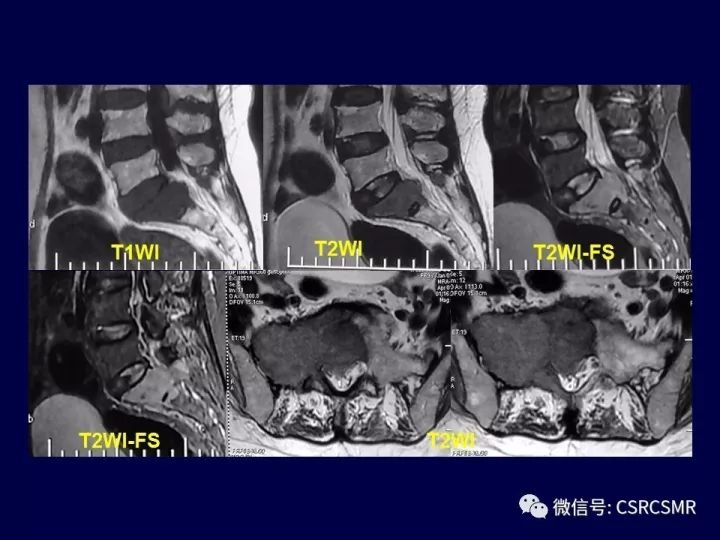 【PPT】骶骨病变的影像诊断与鉴别诊断