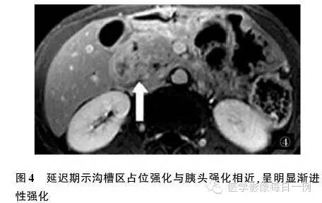 【病例】沟槽状/局限性胰腺炎1例CT影像表现
