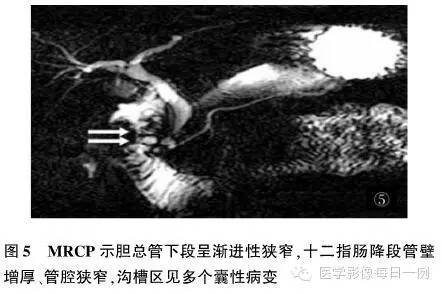 【病例】沟槽状/局限性胰腺炎1例CT影像表现