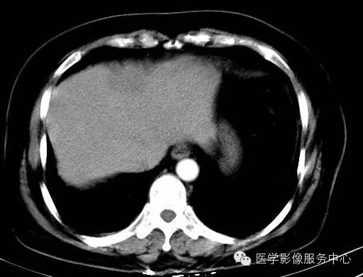【病例】肝海绵状血管瘤1例CT影像表现