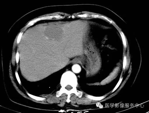 【病例】肝海绵状血管瘤1例CT影像表现