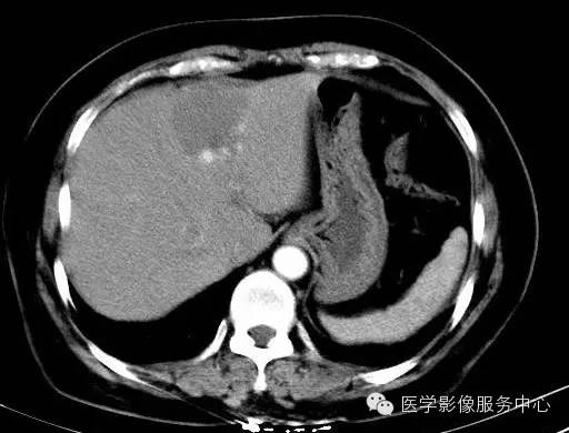 【病例】肝海绵状血管瘤1例CT影像表现