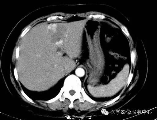【病例】肝海绵状血管瘤1例CT影像表现
