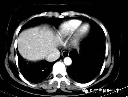 【病例】肝海绵状血管瘤1例CT影像表现