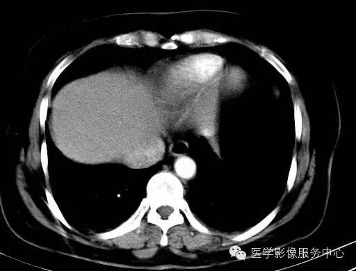 【病例】肝海绵状血管瘤1例CT影像表现