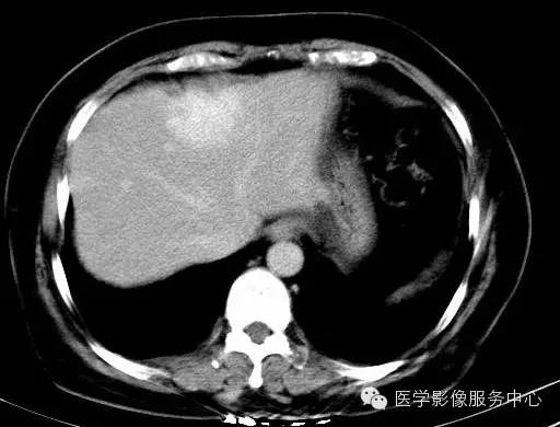 【病例】肝海绵状血管瘤1例CT影像表现