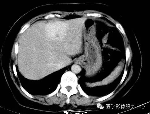 【病例】肝海绵状血管瘤1例CT影像表现