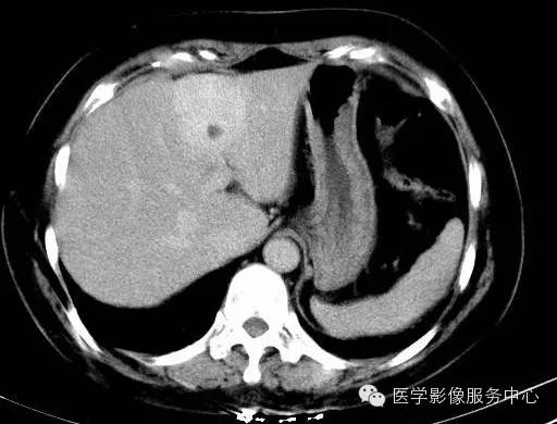 【病例】肝海绵状血管瘤1例CT影像表现