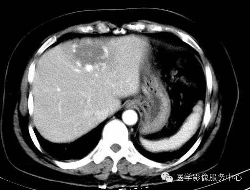 【病例】肝海绵状血管瘤1例CT影像表现