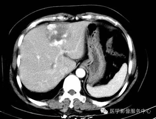 【病例】肝海绵状血管瘤1例CT影像表现