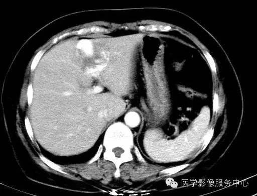 【病例】肝海绵状血管瘤1例CT影像表现