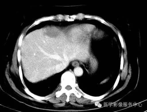 【病例】肝海绵状血管瘤1例CT影像表现