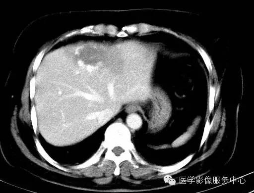 【病例】肝海绵状血管瘤1例CT影像表现