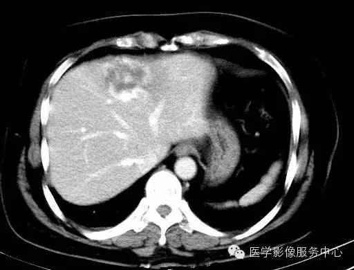 【病例】肝海绵状血管瘤1例CT影像表现