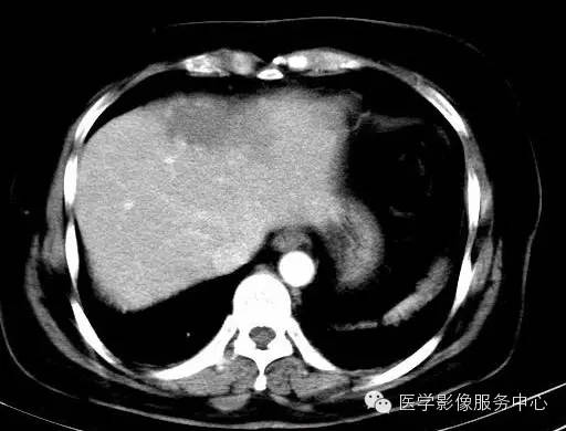 【病例】肝海绵状血管瘤1例CT影像表现