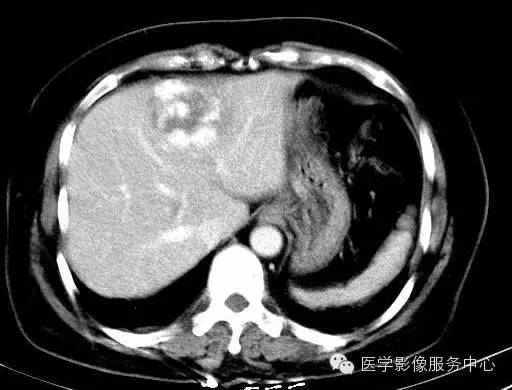 【病例】肝海绵状血管瘤1例CT影像表现