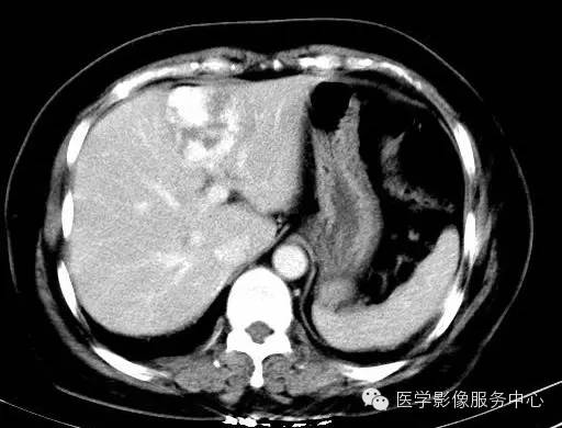 【病例】肝海绵状血管瘤1例CT影像表现