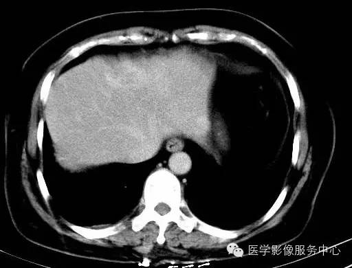 【病例】肝海绵状血管瘤1例CT影像表现