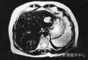 【病例】肝海绵状血管瘤1例CT影像表现