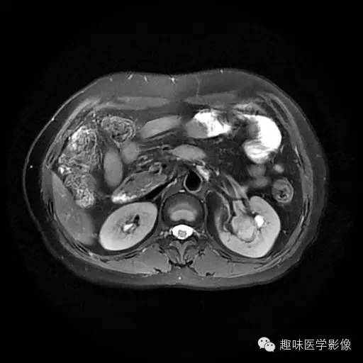 【病例】肾神经鞘瘤1例MR影像表现