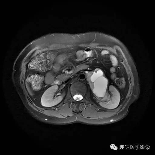 【病例】肾神经鞘瘤1例MR影像表现