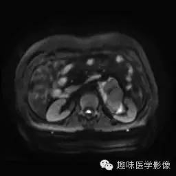【病例】肾神经鞘瘤1例MR影像表现