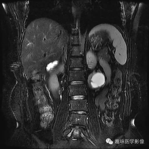 【病例】肾神经鞘瘤1例MR影像表现