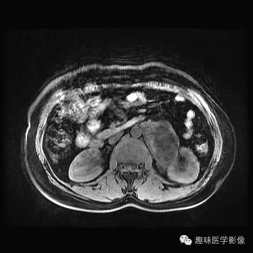【病例】肾神经鞘瘤1例MR影像表现