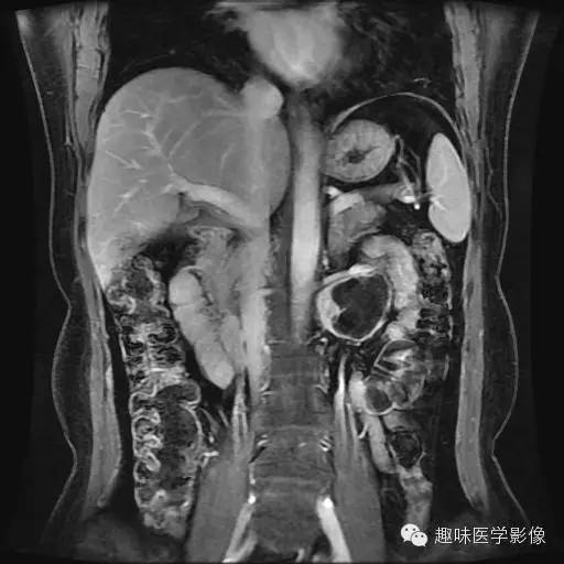 【病例】肾神经鞘瘤1例MR影像表现