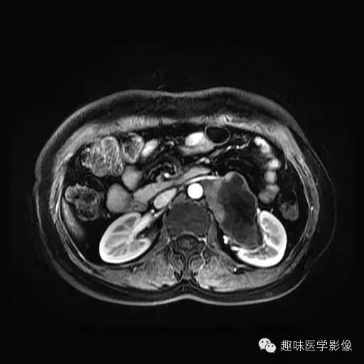 【病例】肾神经鞘瘤1例MR影像表现