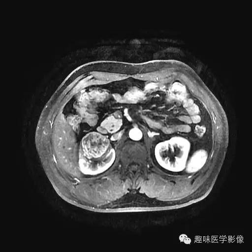 【病例】肾细胞癌1例MR影像表现