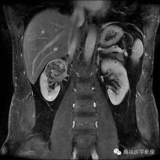 【病例】肾细胞癌1例MR影像表现