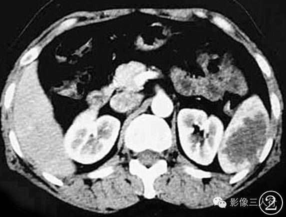 【病例】脾脏淋巴管瘤的CT表现