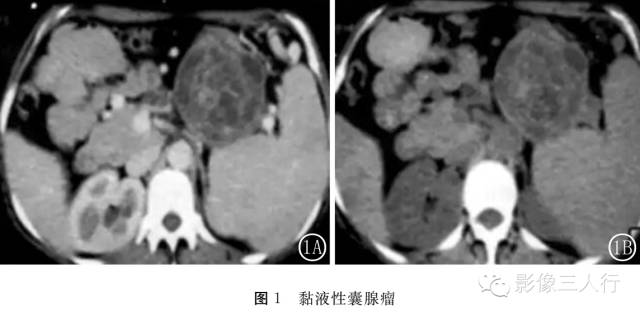 胰腺黏液性囊腺瘤及囊腺癌的CT诊断鉴别分析