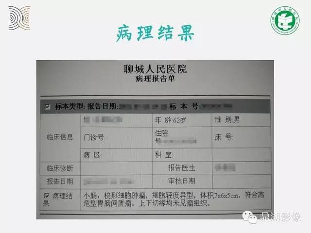 【病例】小肠胃肠道间质瘤1例CT影像表现